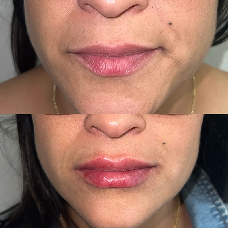 Lip Fillers Before & After Image