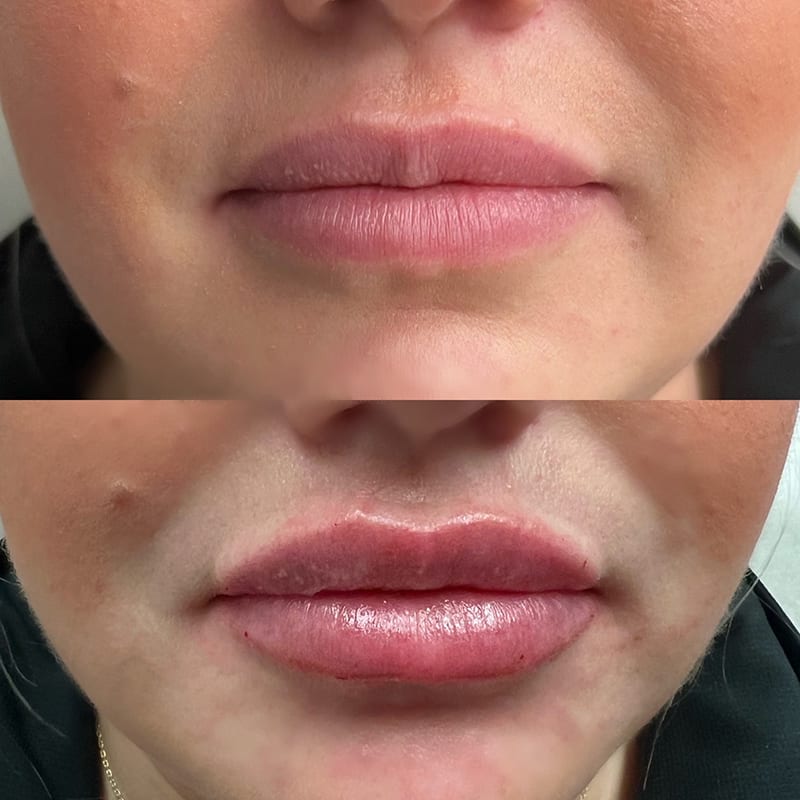 Lip Fillers Before & After Image