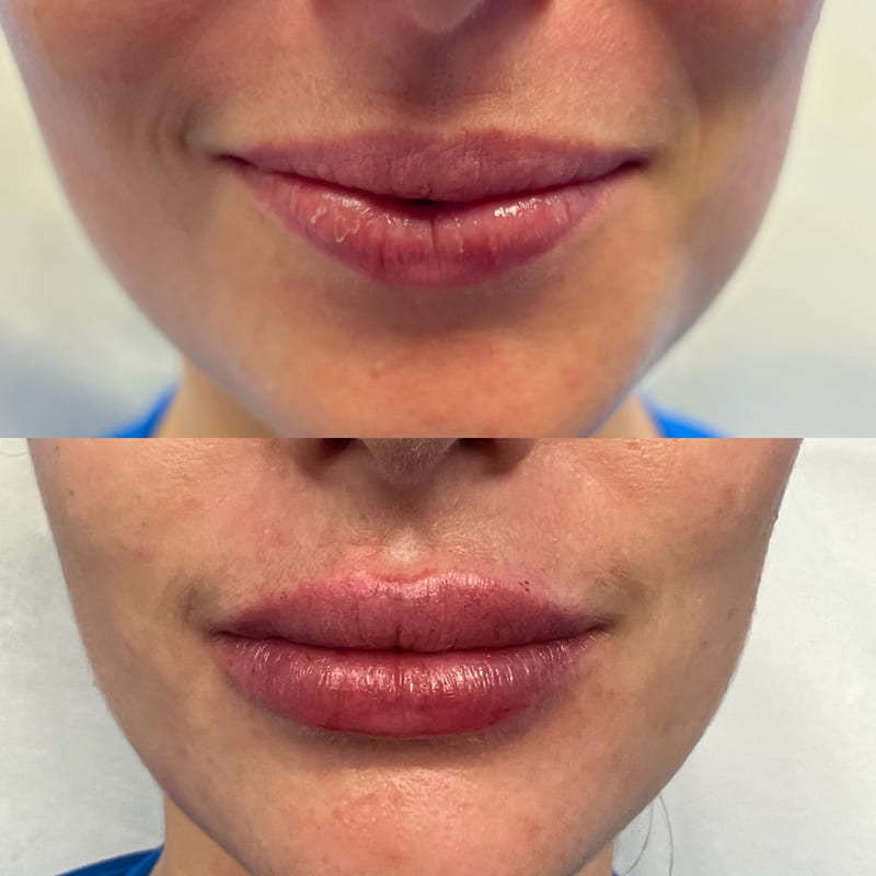 Lip Fillers Before & After Image