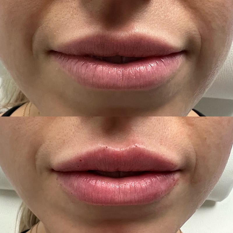 Lip Fillers Before & After Image