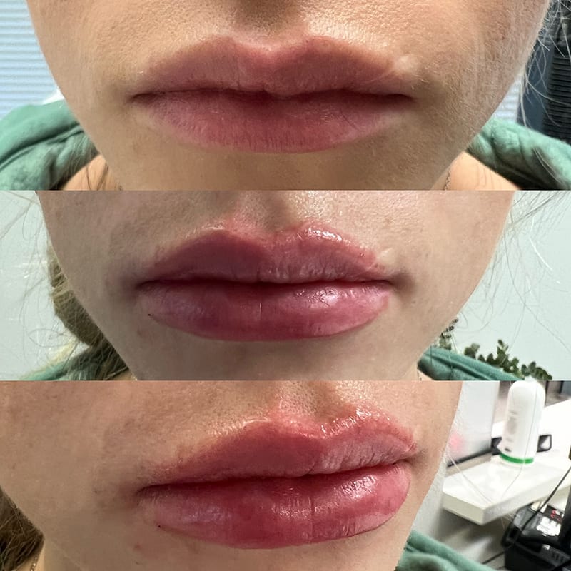 Lip Fillers Before & After Image