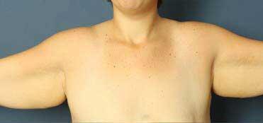 Brachioplasty Before & After Image