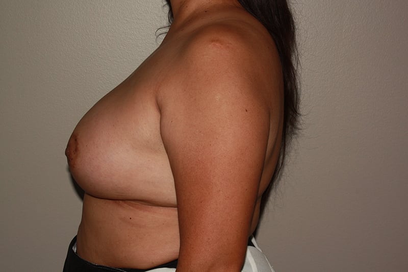 Breast Augmentation Before & After Image