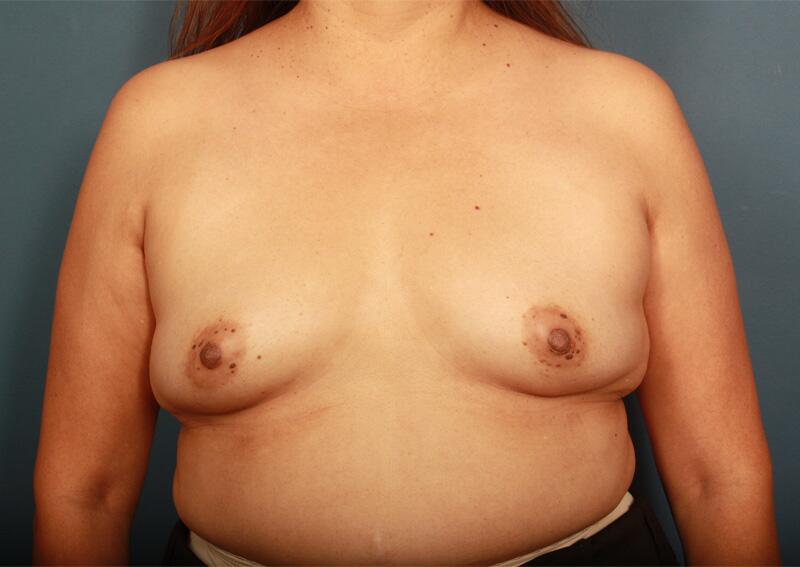 Breast Augmentation Before & After Image