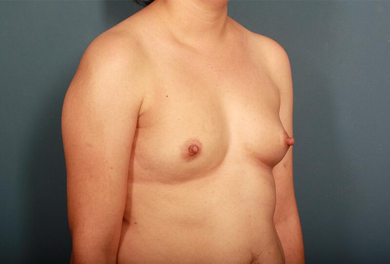 Breast Augmentation Before & After Image