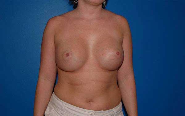 Breast Augmentation Before & After Image