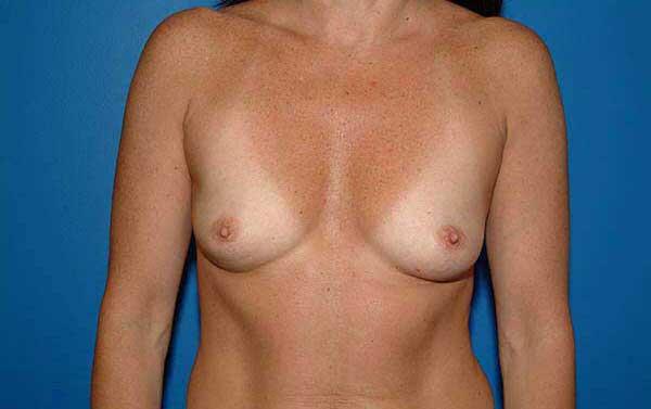 Breast Augmentation Before & After Image