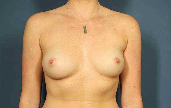 Breast Augmentation Before & After Image