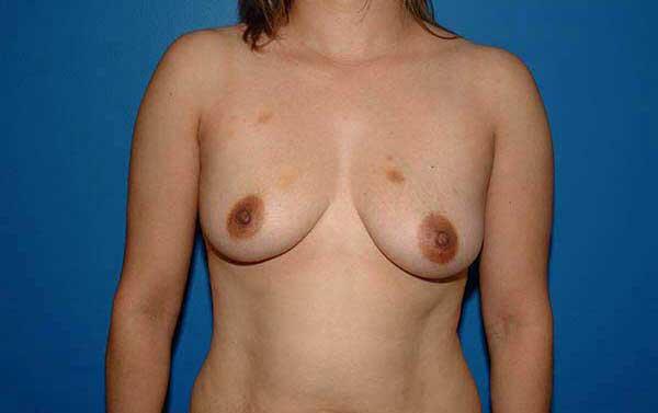 Breast Augmentation Before & After Image