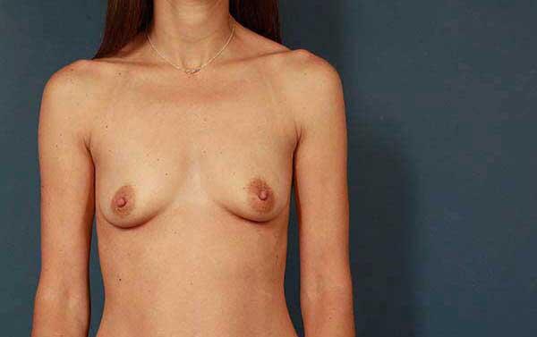 Breast Augmentation Before & After Image