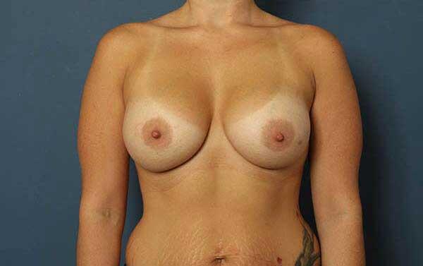 Breast Augmentation Before & After Image