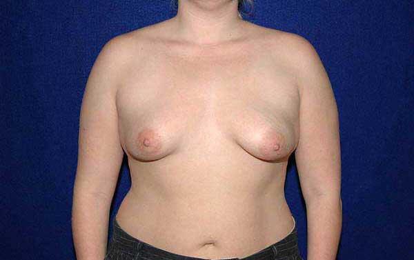 Breast Augmentation Before & After Image