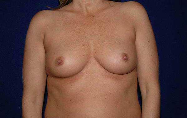 Breast Augmentation Before & After Image