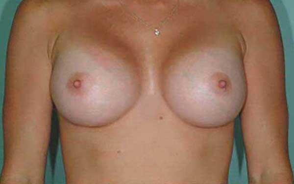 Breast Augmentation Before & After Image