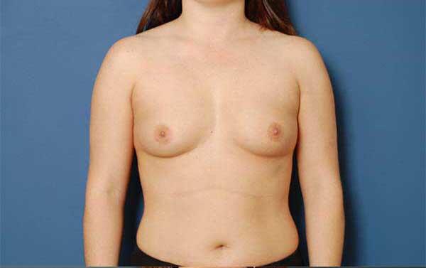 Breast Augmentation Before & After Image