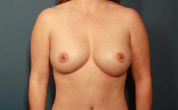 Breast Augmentation Before & After Image