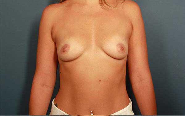 Breast Augmentation Before & After Image