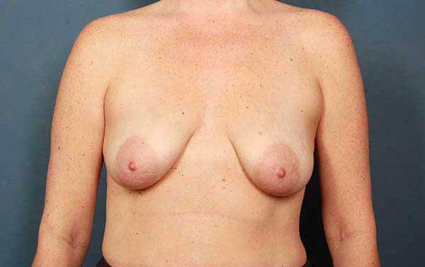 Breast Augmentation Before & After Image