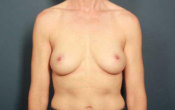 Breast Augmentation Before & After Image