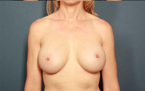 Breast Augmentation Before & After Image