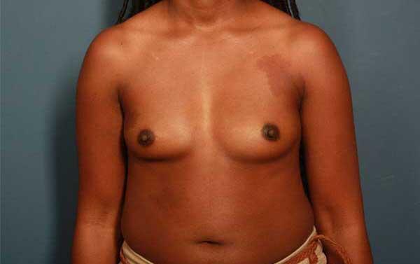 Breast Augmentation Before & After Image