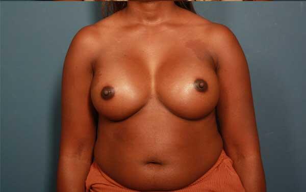 Breast Augmentation Before & After Image