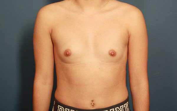 Breast Augmentation Before & After Image