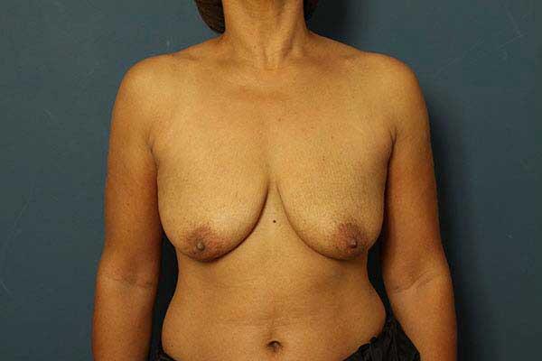 Breast Lift Before & After Image