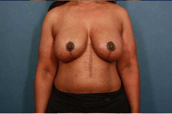 Breast Lift Before & After Image