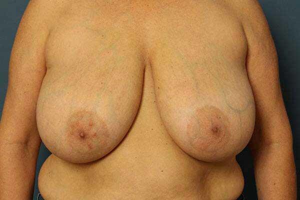 Breast Lift Before & After Image