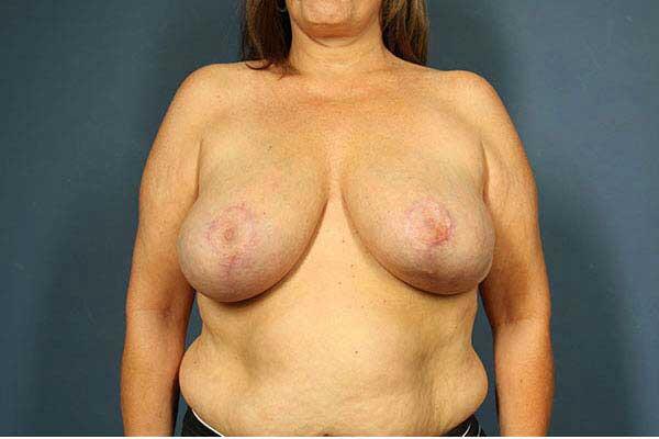 Breast Lift Before & After Image