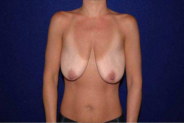 Breast Lift Before & After Image