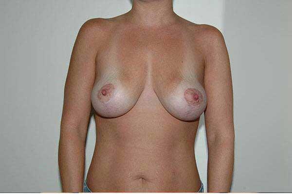 Breast Lift Before & After Image