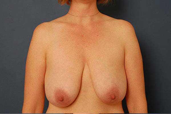 Breast Lift Before & After Image