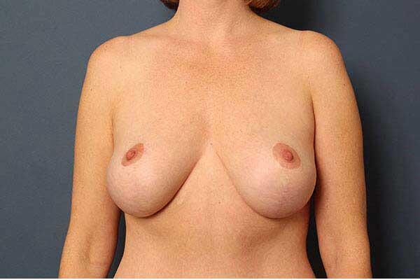Breast Lift Before & After Image