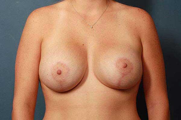 Breast Lift Before & After Image