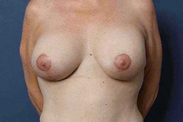 Breast Lift Before & After Image