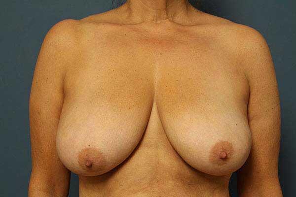 Breast Lift Before & After Image