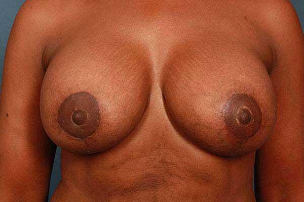 Breast Lift Before & After Image