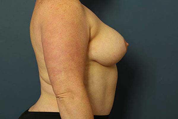 Breast Lift Before & After Image