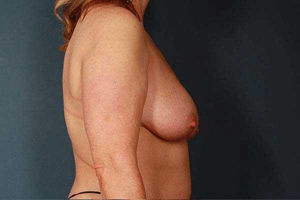 Breast Lift Before & After Image