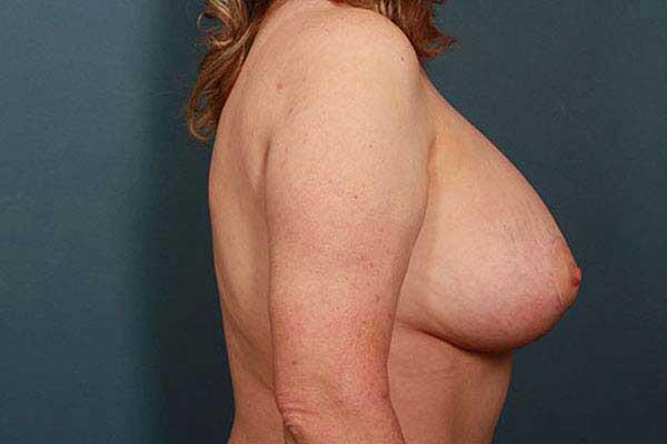 Breast Lift Before & After Image