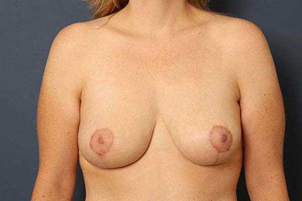 Breast Lift Before & After Image