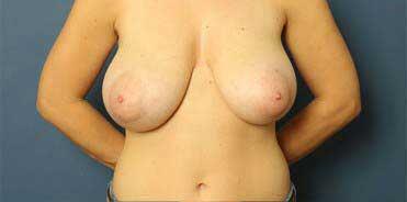 Breast Reduction Before & After Image