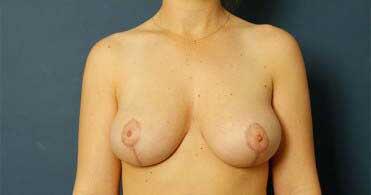 Breast Reduction Before & After Image