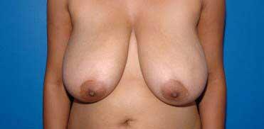 Breast Reduction Before & After Image