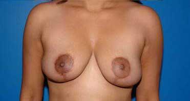 Breast Reduction Before & After Image