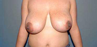 Breast Reduction Before & After Image