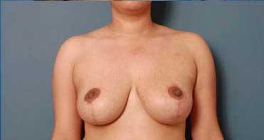 Breast Reduction Before & After Image