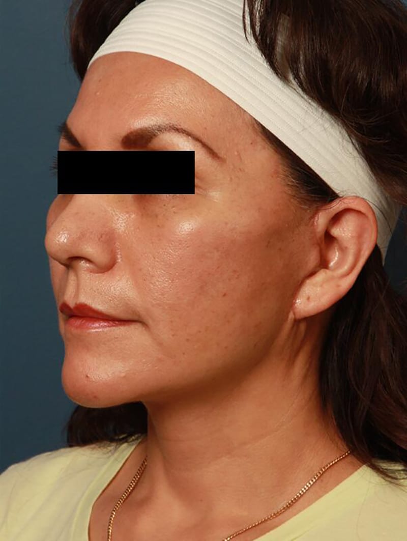 Facelift Before & After Image